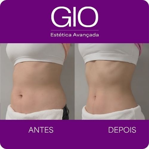 Tratamento para Gordura Localizada