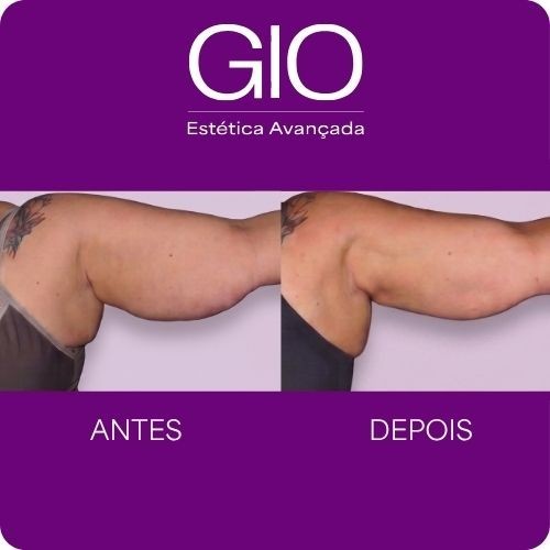 Protocolo GIO para Lipedema