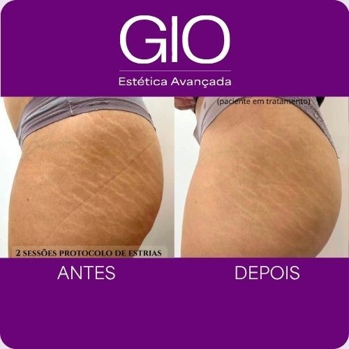Tratamento para Estrias
