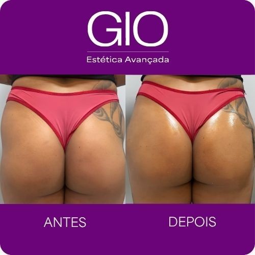 Harmonização de Glúteos